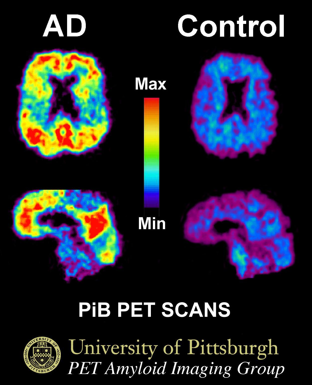 Composición de imágenes PET del cerebro con las etiquetas «AD» y «Control», una escala de colores y vistas en distintos planos.